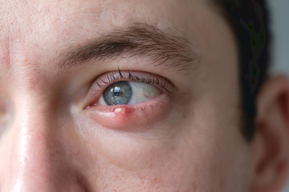 Ung mann med sti på øyet